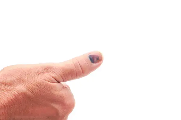 Çürük tırnaklı başparmak, beyaz arka planda subbungual hematom. Acı verici çürükler, kaza, yaralı parmaklar ve tıbbi konsept.