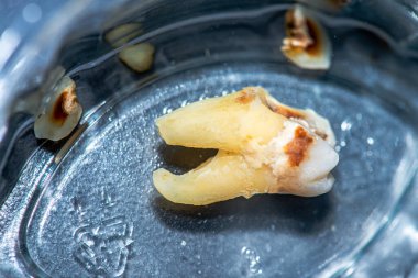 Bir azıdişi dişinin dişçiden sonraki kırık ve parçalanmış durumunu gösteren makro bir fotoğraf, diş ameliyatının detaylı sonuçlarını vurguluyor..