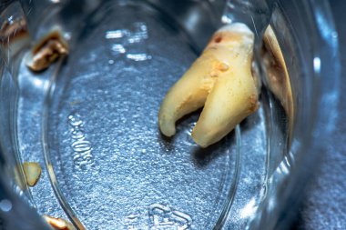 Bir azıdişi dişinin dişçiden sonraki kırık ve parçalanmış durumunu gösteren makro bir fotoğraf, diş ameliyatının detaylı sonuçlarını vurguluyor..