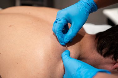 Yetenekli bir fizyoterapist, kronik kas ağrısı ve gerilimi azaltmak için hastalara kuru iğne uygular.