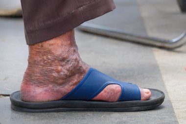 Kuru, kapkara bir cilt ve deri hastalığı gibi bir sürü yumru. Yaşlı adamın derisi yüzülmüş. Deri sağlıksız görünüyor.