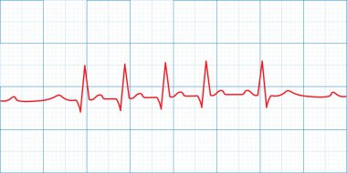 ECG veya EKG grafiğinde kalp atış hızı monitörü açık bir nabız çizgisi ile görüntülendi.