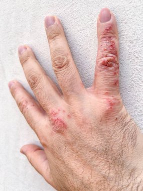 Cildindeki alerjik süreçten dolayı el yaralanması tahriş, yaralar ve kuraklık gösteriyor.