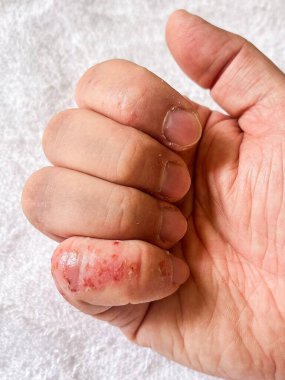 Cildindeki alerjik süreçten dolayı el yaralanması tahriş, yaralar ve kuraklık gösteriyor.