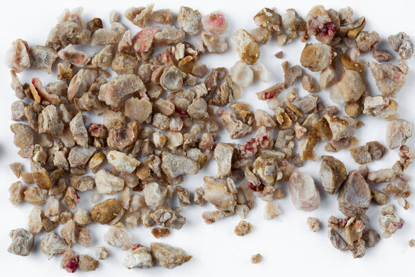 Камни в почках. Камни были удалены из почек пациента