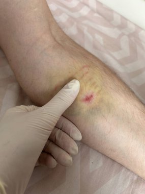 Bir tıp uzmanı, hastanın kolundaki küçük bir yarayı inceliyor. Bölgede morarma ve kızarıklık belirtileri var. Bu da son travmayı gösteriyor. Çevre klinik görünüyor, uygun görünüyor.