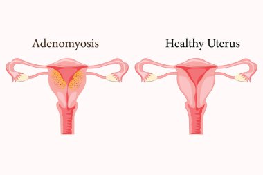 Yaygın Adenomyosis İnsan Anatomisi Kadın Üreme Hastalığı Sistemi Normale Karşı. Eğitimsel sağlıklı ve anormal anatomi organları rahim. 10 yaşında. Tıbbi illüstrasyon.