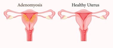 Yaygın Adenomyosis İnsan Anatomisi Kadın Üreme Hastalığı Sistemi Normale Karşı. Eğitimsel sağlıklı ve anormal anatomi organları rahim. 10 yaşında. Tıbbi illüstrasyon.