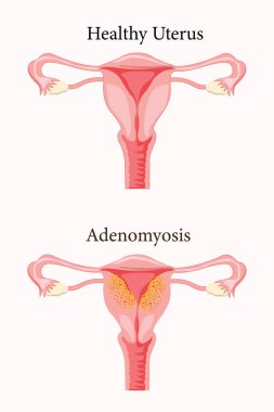 Yaygın Adenomyosis İnsan Anatomisi Kadın Üreme Hastalığı Sistemi Normale Karşı. Eğitimsel sağlıklı ve anormal anatomi organları rahim. 10 yaşında. Tıbbi illüstrasyon.