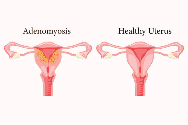 Diffuse Adenomyosis Human anatomy Female reproductive Sick system vs versus normal. Compared educational healthy and abnormal anatomy organs uterus. eps 10. medical illustration