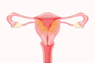 Adenomiyozis. Kadın üreme sisteminin anatomik çizimi. Adenozis semptomları ve notlarla birlikte. Vektör tıbbi illüstrasyon