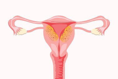 Adenomyosis.  Anatomical illustration of the female reproductive system with symptoms of adenomyosis, with annotations. Vector medical illustration clipart