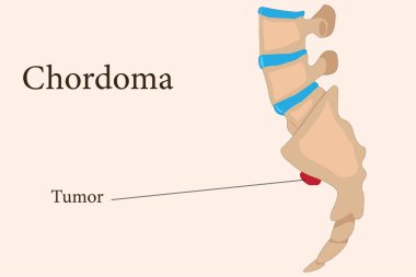 Illustration of chordoma tumors located at the skull base and sacrum in the spine clipart