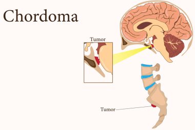 Kafatası tabanında kordoma tümörleri ve omurgada sakrum saptanmış. Tıbbi illüstrasyon. 10 saniye.