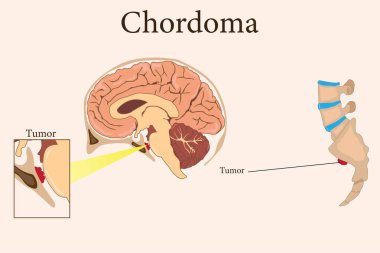 Kafatası tabanında kordoma tümörleri ve omurgada sakrum saptanmış. Tıbbi illüstrasyon. 10 saniye.