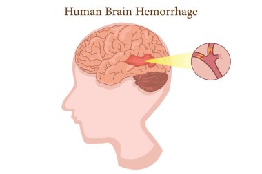 Kafa tutması. Beyaz arka planda insan anatomisi hastalığı kanamalı vektör çizimi. 10 saniye.
