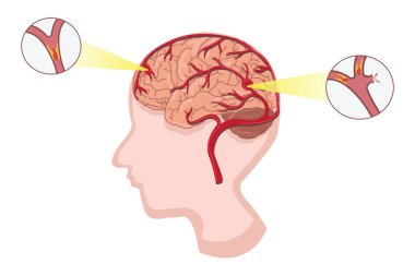 İnsan anatomisi hastalığı İskemik felç vektörü ve beyaz arka planda kanamalı felç çizimi. 10 saniye.
