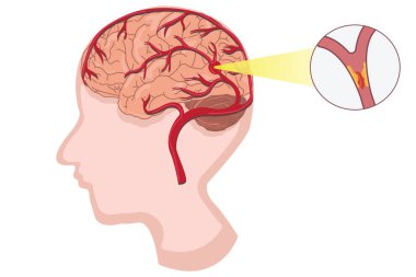 Beyaz arka planda insan anatomisi hastalığı iskemik felç vektör çizimi. Beyin problemi 10.