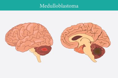 İnsan anatomisi hastalığı. Beyaz arka planda medulloblastoma vektör çizimi. 10 saniye.