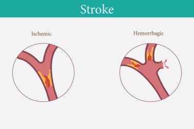 İnsan anatomisi hastalığı İskemik felç vektörü ve beyaz arka planda kanamalı felç çizimi. 10 saniye.