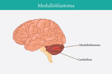 İnsan anatomisi hastalığı. Beyaz arka planda medulloblastoma vektör çizimi. 10 saniye.