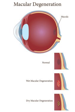 Age-related macular degeneration.Eye vision disorder. vector eps 10 clipart