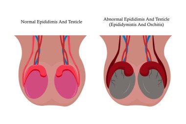 illustration of epididimitis (inflamasi epididimis). Epididymitis is inflammation of the epididymis which is generally caused by a bacterial infection. eps 10 clipart