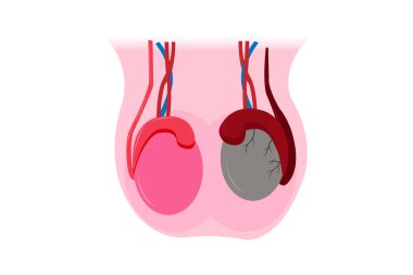 illustration of epididimitis (inflamasi epididimis). Epididymitis is inflammation of the epididymis which is generally caused by a bacterial infection. eps 10 clipart