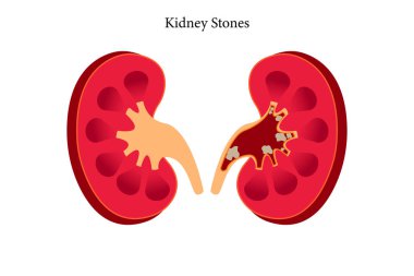 Nephrolithiasis böbrek taşı hastalığı. Vektör tıbbi illüstrasyonunun çapraz bölümü. 10 saniye.
