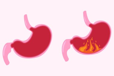 Mide ikonu seti, karikatür vektör çizimi. Normal ve anormal midenin kesiti. Beyaz arka planda izole edilmiş. 10 saniye.