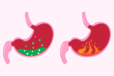 Mide ikonu seti, karikatür vektör çizimi. Normal ve anormal midenin kesiti. Beyaz arka planda izole edilmiş. 10 saniye.