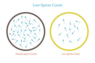 Normal ve düşük sperm sayısı çizimi. Erkek kısırlığı oligospermisi. Spermin yapısı. Vektör. 10 saniye.