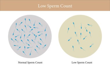 Normal ve düşük sperm sayısı çizimi. Erkek kısırlığı oligospermisi. Spermin yapısı. Vektör. 10 saniye.