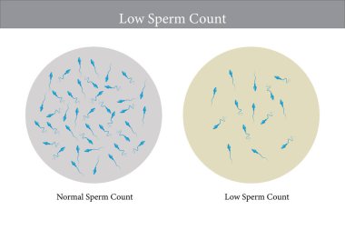 Normal ve düşük sperm sayısı çizimi. Erkek kısırlığı oligospermisi. Spermin yapısı. Vektör. 10 saniye.
