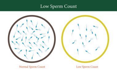 Normal ve düşük sperm sayısı çizimi. Erkek kısırlığı oligospermisi. Spermin yapısı. Vektör. 10 saniye.
