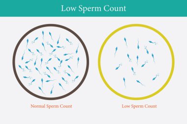 Normal ve düşük sperm sayısı çizimi. Erkek kısırlığı oligospermisi. Spermin yapısı. Vektör. 10 saniye.