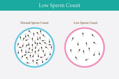 Normal ve düşük sperm sayısı çizimi. Erkek kısırlığı oligospermisi. Spermin yapısı. Vektör. 10 saniye.