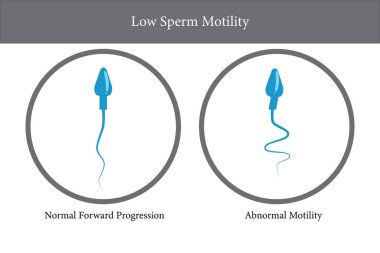 Sperm motility, low sperm count, Semen analysis, vector illustration eps10 clipart