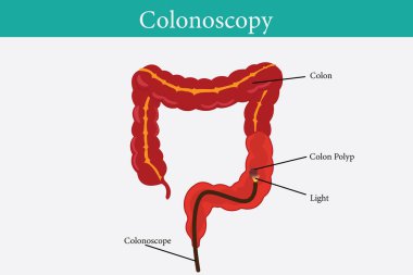 Kolonoskopi tedavisi, ailevi adenomatöz poliposis. İnce bağırsağın muayene ve teşhisi. Gastrointestinal bozukluk anatomik