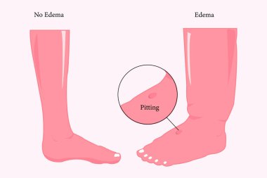 Normal ve anormal ayak. Eğitim için ayak ödemi illüstrasyonu. Vektör çizimi. 10 saniye.