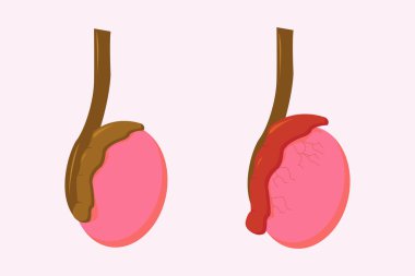 illustration of epididimitis (inflamasi epididimis). Epididymitis is inflammation of the epididymis which is generally caused by a bacterial infection clipart