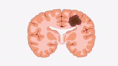 2D animasyon insan beyninin bir kesitini gösteriyor, glioblastomayı gösteriyor, bir beyin kanseri türü. Şaşırtıcı 4K çözünürlükte sunuldu
