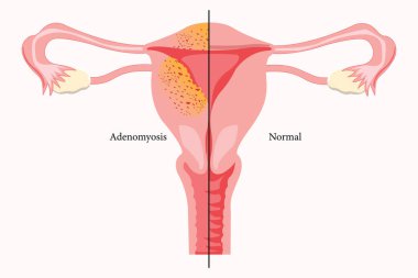 Yaygın Adenomyosis İnsan Anatomisi Kadın Üreme Hastalığı Sistemi Normale Karşı. Eğitimsel sağlıklı ve anormal anatomi organları rahim. 10 yaşında. Tıbbi illüstrasyon.