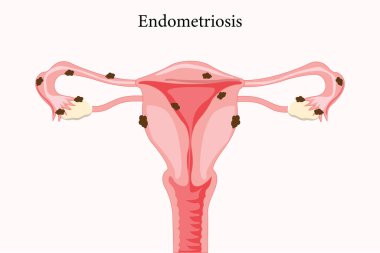 Rahmin dışında büyüyen rahim dokusunu gösteren bir endometriyozis örneği. Tıbbi illüstrasyon. 10 saniye.