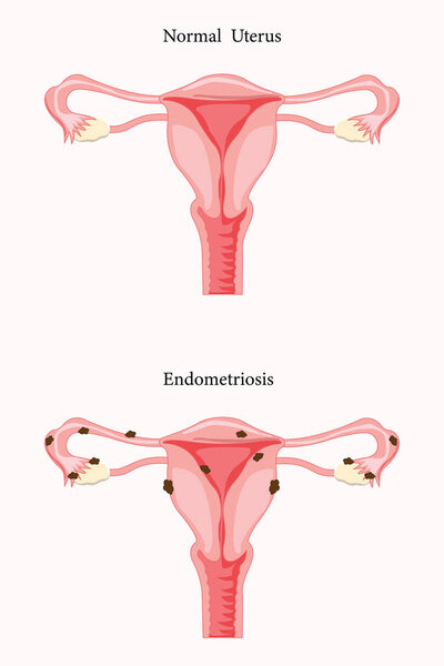 Anatomical illustration of the  female reproductive system with the symptoms of adenomyosis and the symptoms of endometrioses, with annotations. eps 10
