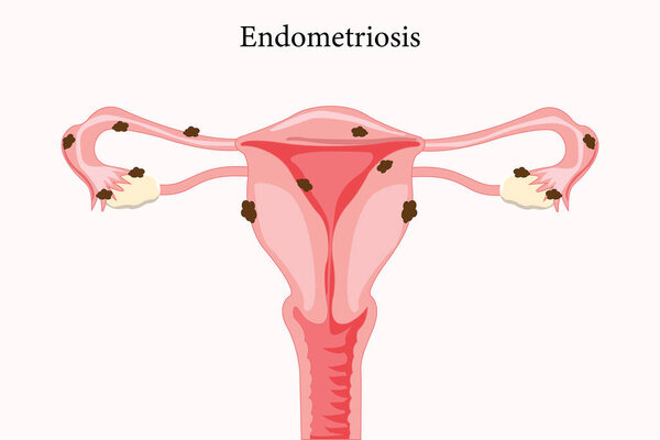 An illustration of endometriosis showing uterine tissue growing outside the uterus. medical illustration. eps 10