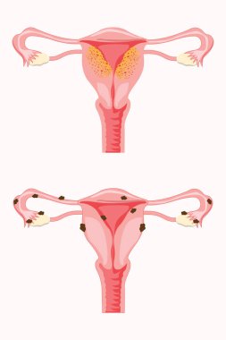 Kadın üreme sisteminin anatomik örneklemesi. Adenozis belirtileri ve endometriyozis belirtileri, notlar. 10 saniye.