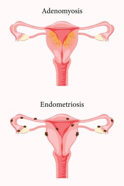 Kadın üreme sisteminin anatomik örneklemesi. Adenozis belirtileri ve endometriyozis belirtileri, notlar. 10 saniye.