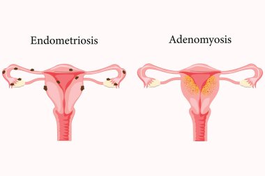 Kadın üreme sisteminin anatomik örneklemesi. Adenozis belirtileri ve endometriyozis belirtileri, notlar. 10 saniye.