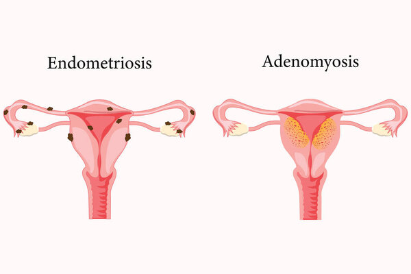 Anatomical illustration of the  female reproductive system with the symptoms of adenomyosis and the symptoms of endometrioses, with annotations. eps 10